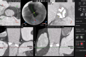 Low Mortality and Stroke Rates With BASILICA Pre-TAVI, Registry Shows